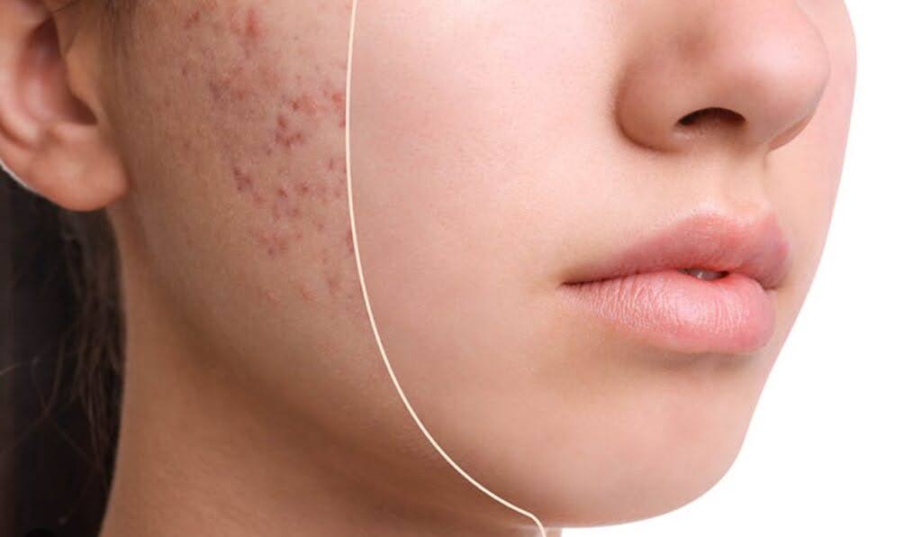 وداعًا للحبوب! خطوات فعّالة لعلاج حب الشباب نهائيًا!